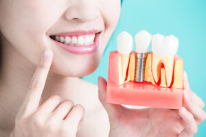 Look Younger With Dental Implants