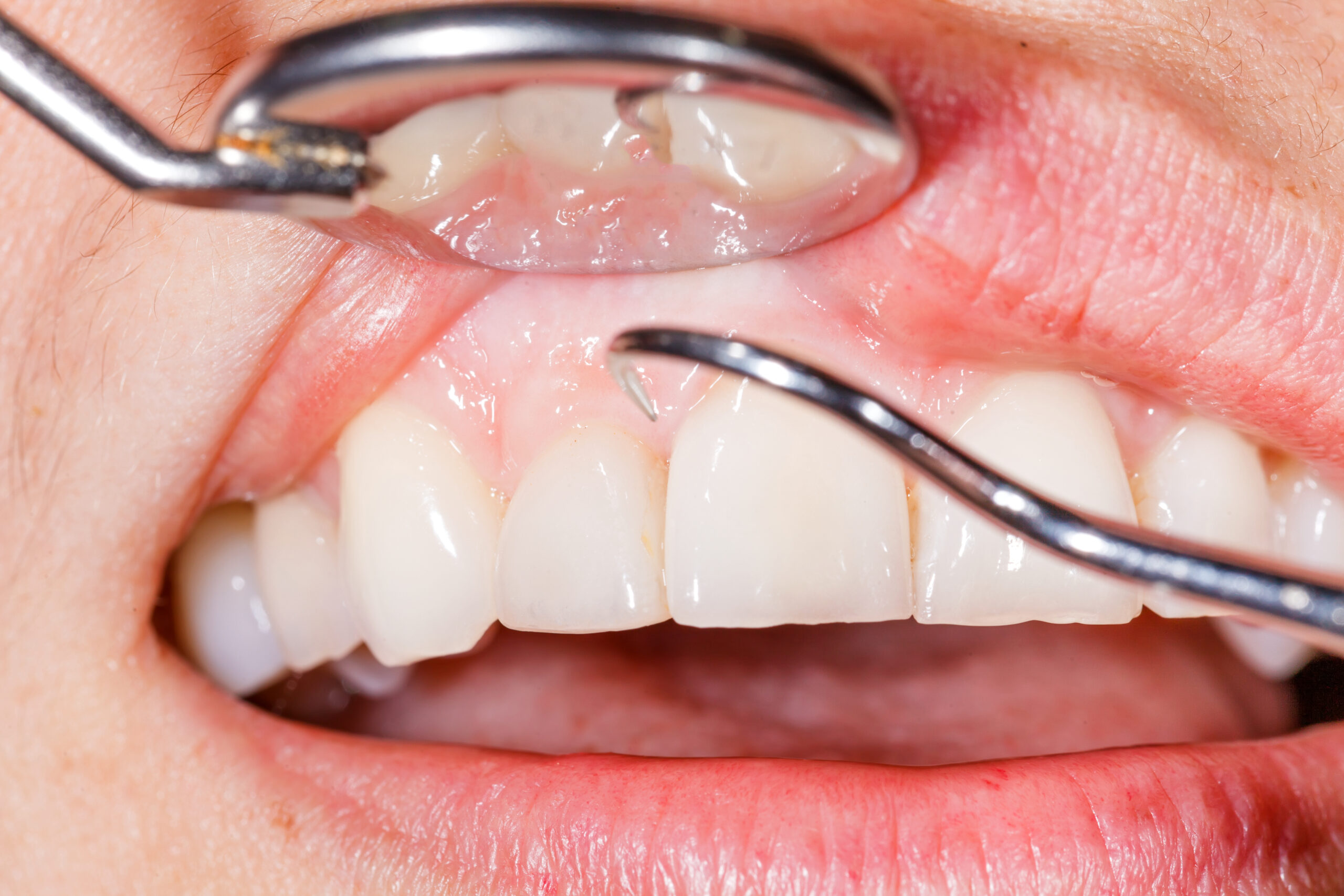 Five Important Risk Factors for Gum Disease