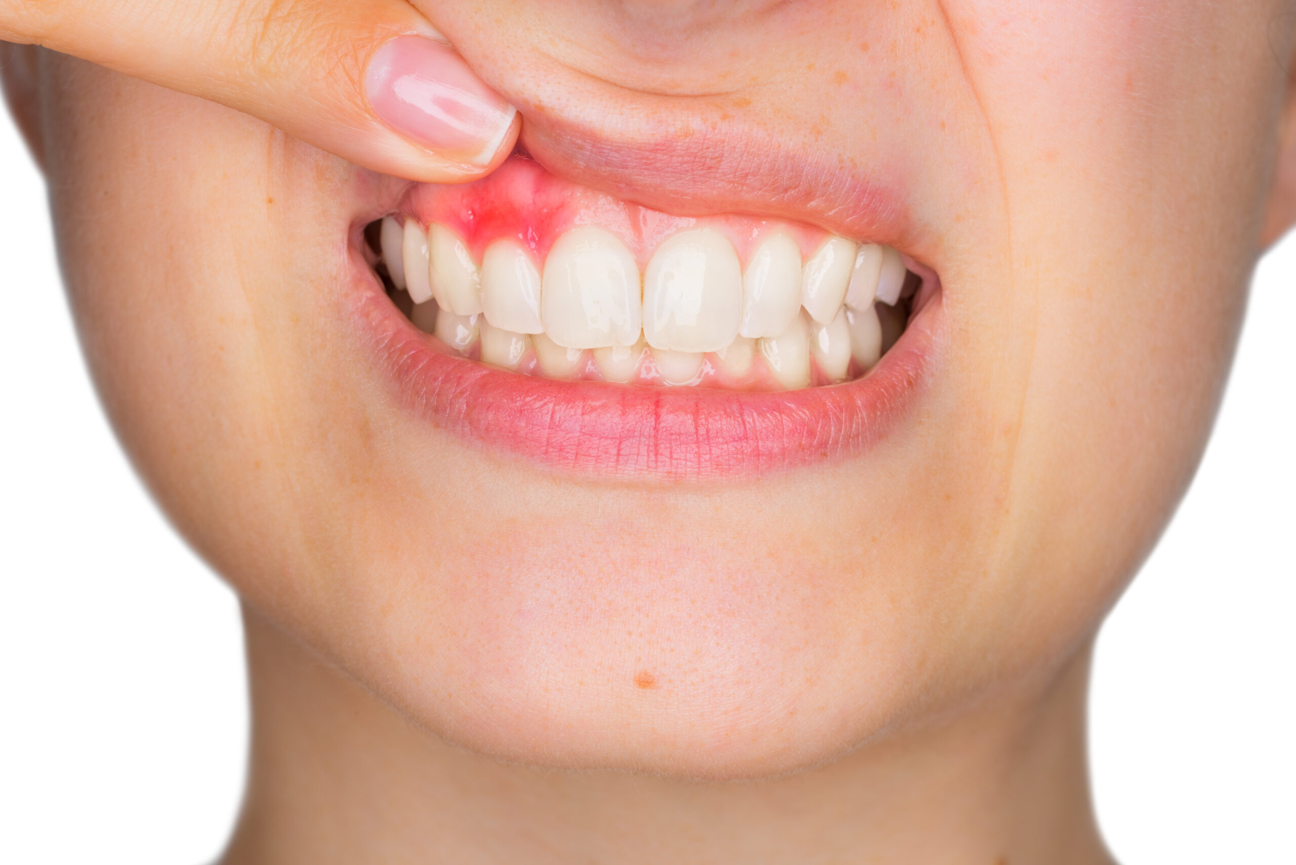 Is Periodontal Disease Causing Your Tooth Sensitivity?