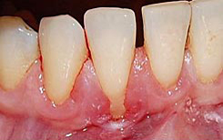 How do you know if a gum graft failed