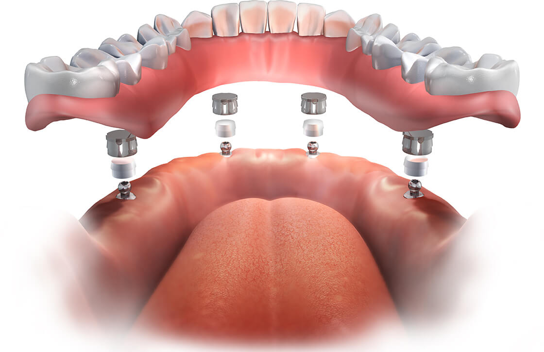 dental implant technology