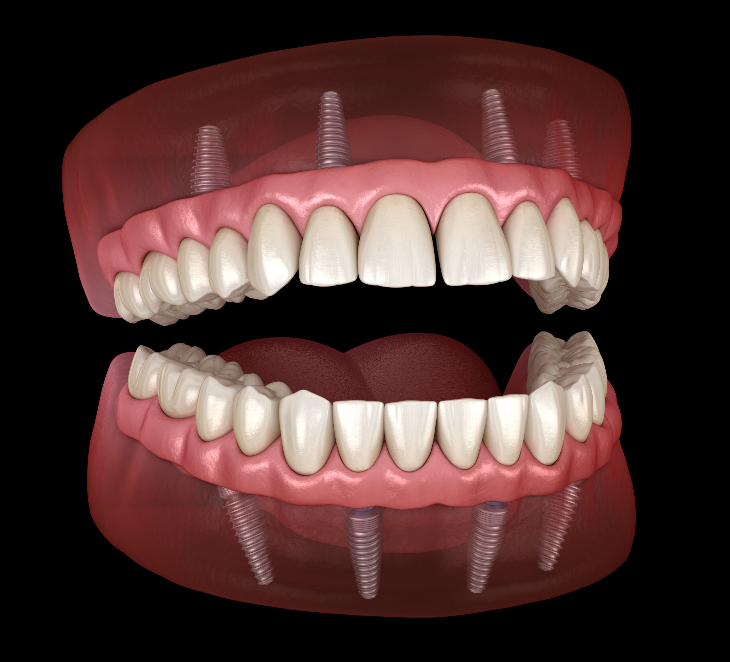 All-on-4Ⓡ Dental Implants