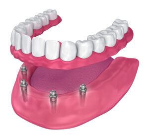 All-on-4® dental implants