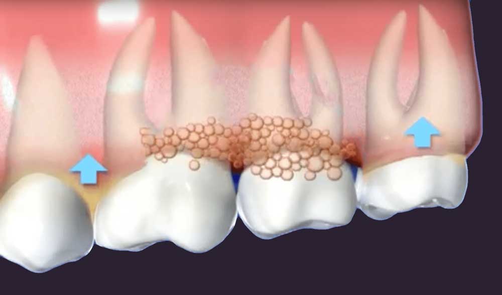 diagram depicting gums infected with periodontal disease