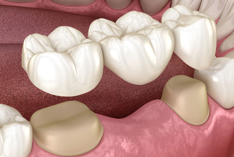How A Dental Bridge Fits In Your Mouth