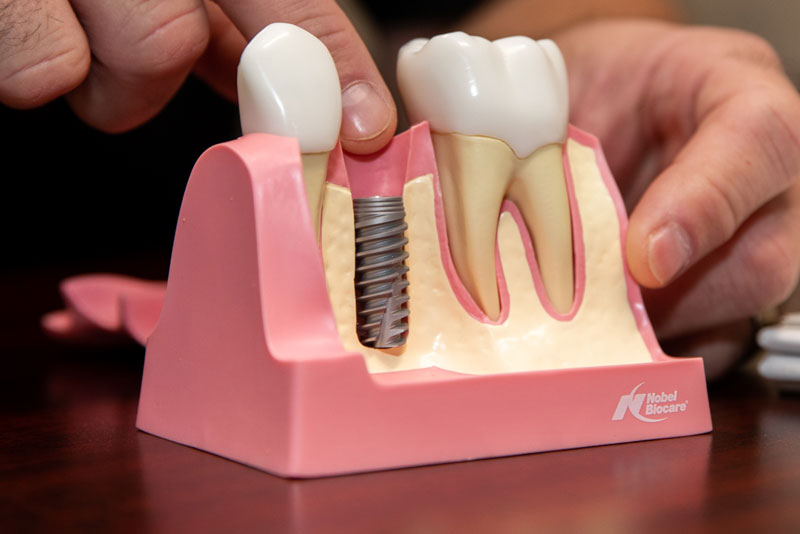 Dental Implants In Your Bone, Model
