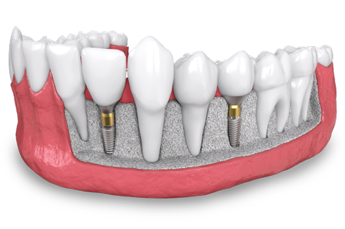 a model of two placed dental implants