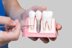 Dental Assistant Showing Off A Dental Implant In A Jawbone Cutaway Model in Houston, TX