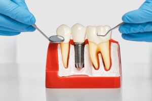 A dental implant model bone cutaway showing Osseointegration