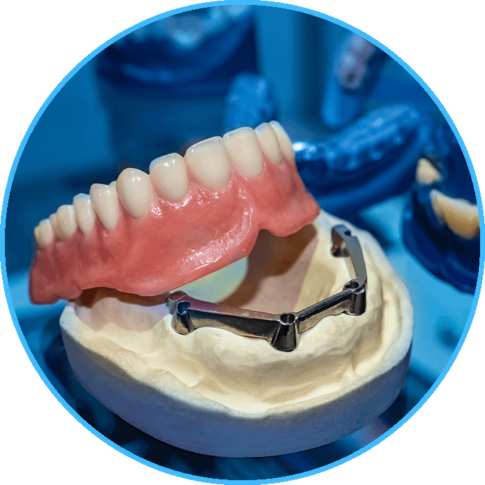 bar retained dentures