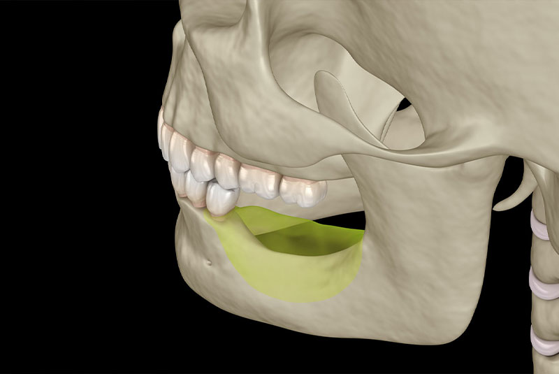 jawbone loss