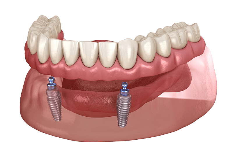 implant dentures