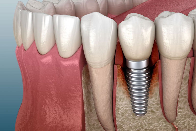 peri implantitis