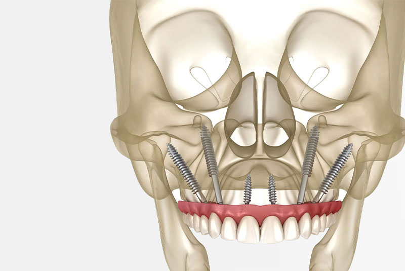 zygomatic dental implants