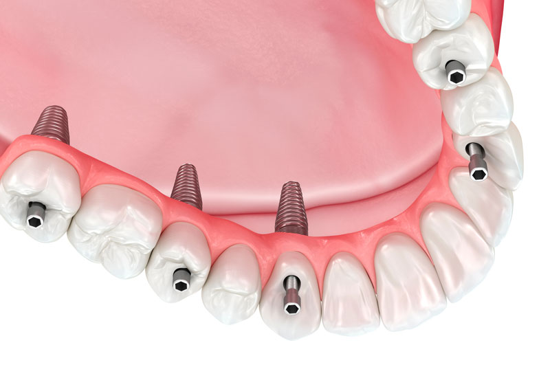 dental implant prosthetic being placed on dental implant posts.